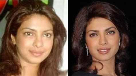 Rakhi Sawant Before And After Plastic Surgery Pictures