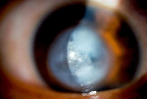 Keratoconus Hydrops American Academy Of Ophthalmology