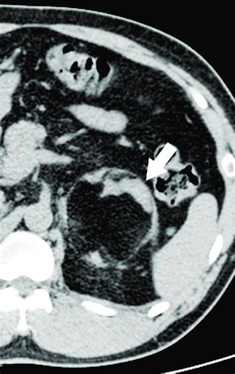 Adrenal Myelolipoma In The Left Adrenal Gland Of A 39 Year Old Man