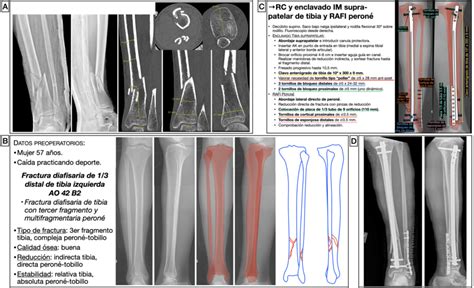 Preoperative Planning Of Distal Tibial Diaphyseal Fracture A X Ray