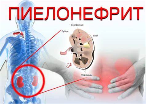 Пиелонефрит диета для мужчин