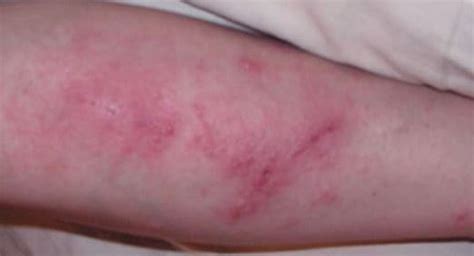 Poison Sumac Rash Pictures Treatment How To Get Rid