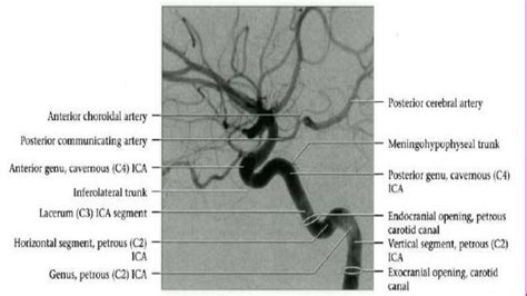 Segments of internal carotid artery | Internal carotid ...