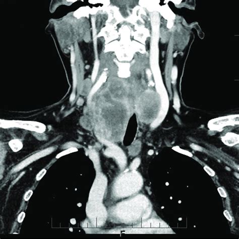 Cervical Computed Tomography Scan Showing Voluminous Tumor Of The