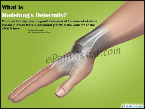 What Is Madelungs Deformity And How Is It Treated
