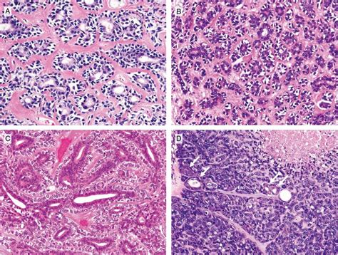 The Histologic Features Of Salivary Gland Tumors Resembling