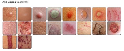 Lesionmapper Pictographic Lesion Encoder For Dermatology