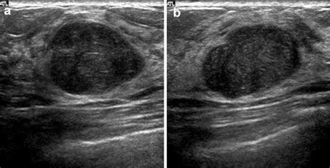 Phyllodes Tumors Of The Breast Ultrasonographic Findings And