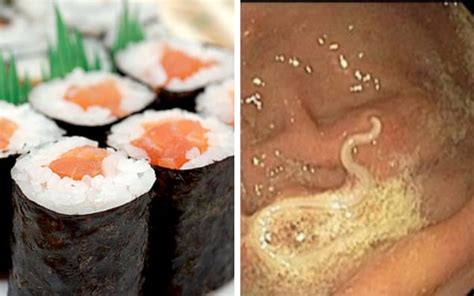 Sushi Warning As Patient Found With Live Worms Writhing In Gut