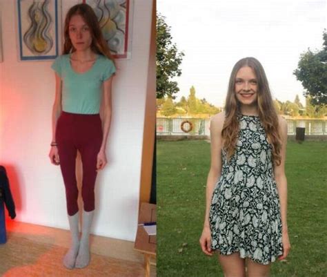 Anorexic Girl Was Only Several Days Away From Death But Managed To
