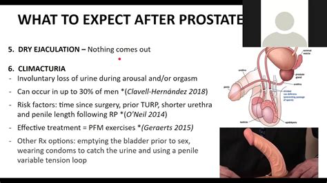 Incontinence Erectile Dysfunction Post Prostatectomy YouTube