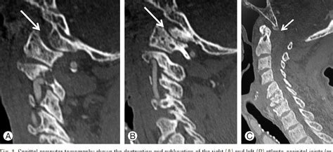 Figure 1 From Surgical Treatment For Atlanto Occipital Subluxation Due