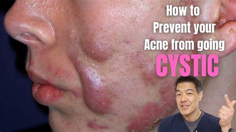 How To Prevent Acne From Going Cystic Youtube