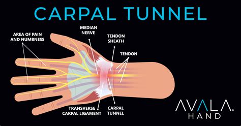 Carpal Tunnel Syndrome Avala