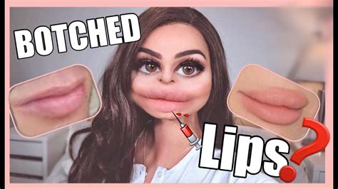 LIP INJECTIONS GONE WRONG YouTube
