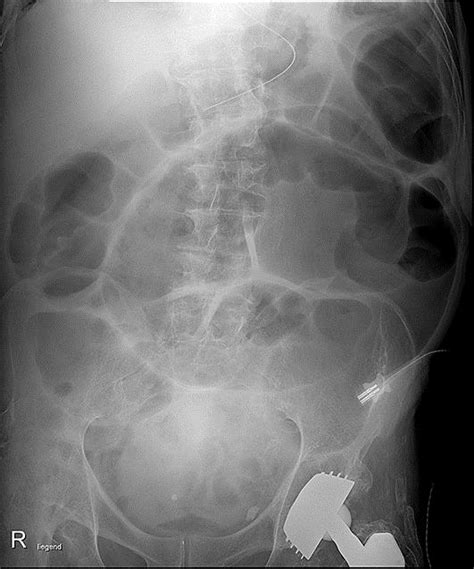 Plain Abdominal X Ray Image Depicting The Sigmoid Volvulus Indicating