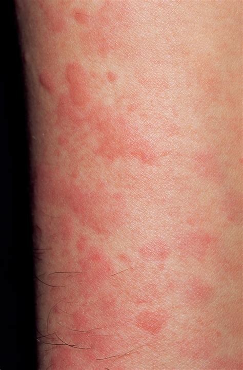 Urticaria Reaction Photograph By Dr P Marazziscience Photo Library