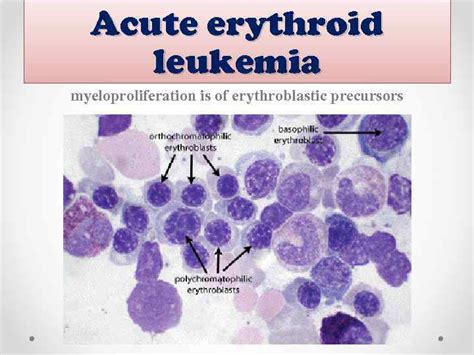 Department Of Pathological Anatomy Acute Myeloid Leukemia Prepared
