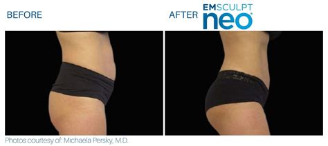 Emsculpt Neo Butt Lifts Explained With Before After Pictures