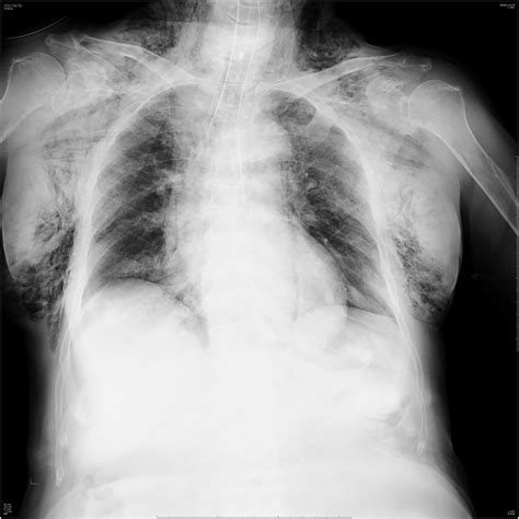 Chest Radiograph On Admission Showing Subcutaneous And Mediastinal