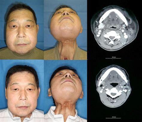 Lymphaticovenous Anastomosis For Facial Lymphoedema After Multiple
