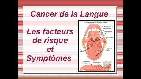 Cancer De La Langue Facteurs De Risque Et Symptômes Youtube