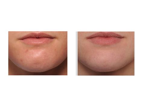 Fat Injections For Reducing The Appearance Of Chin Dimples Explore Plastic Surgery