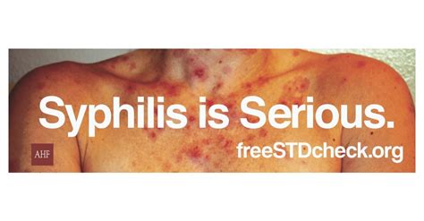 New Ahf Billboards Warn ‘syphilis Is Serious Business Wire