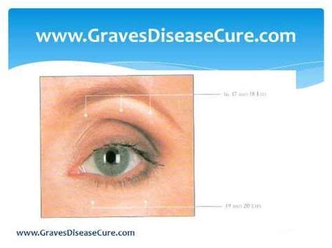 Thyroid Eye Disease and Its Healing- Exercises - YouTube | Thyroid
