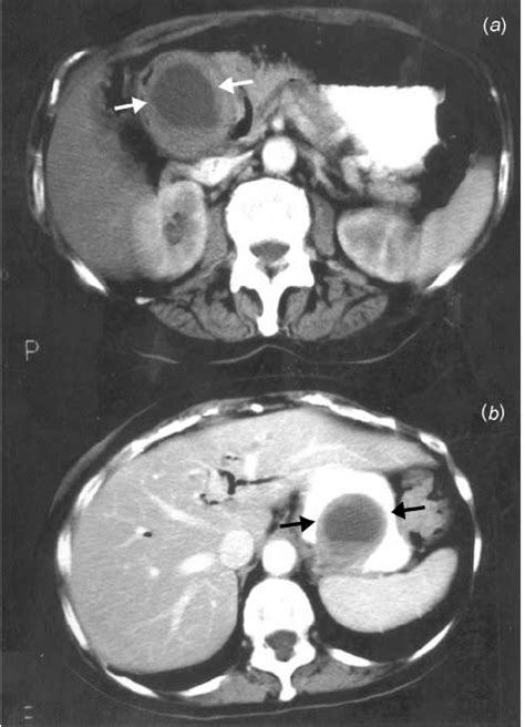 Contrast Enhanced Abdominal Ct Scans A White Arrows Download