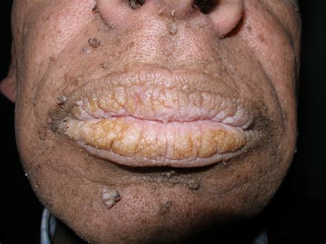 Occult Neoplasm In A Patient With Acanthosis Nigricans Eurorad