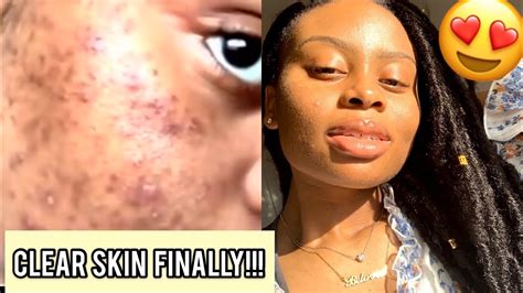 I Faded My Acne Scars Got Clear Skin Doing This Youtube