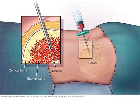 Doctors use these procedures to diagnose and monitor blood and marrow diseases, including some cancers, as well as fevers of unknown origin. Bone marrow biopsy and aspiration - Mayo Clinic