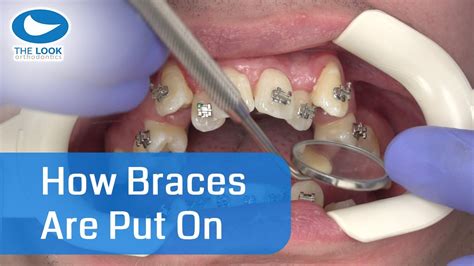 How Braces Are Put On Amazing Now With 12 Month Progress