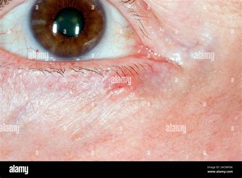 Close Up Of Basal Cell Carcinoma Bcc Or Rodent Ulcer On The Skin Of