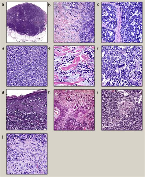 An Update On Diagnostic Features Of Merkel Cell Carcinoma Diagnostic