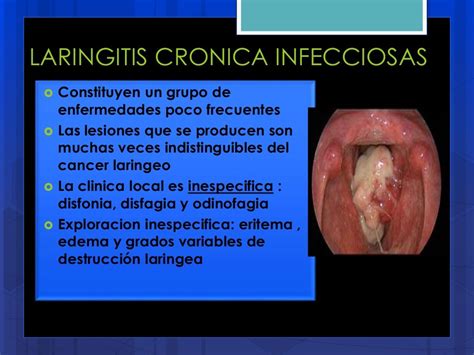 Laringitis Cronica