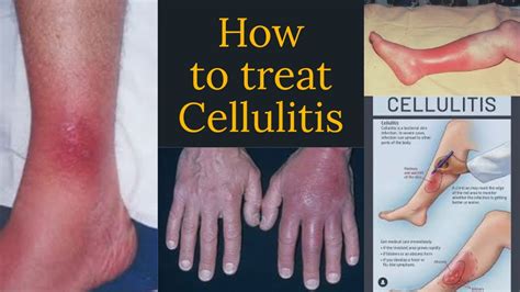 Iv Antibiotics For Cellulitis Youtube