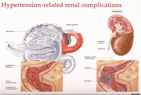 Early renal success refers to renal dysfunction, principally an acute azotemia, that is due to prerenal causes. Hypertensive Renal Disease. Causes, symptoms, treatment ...