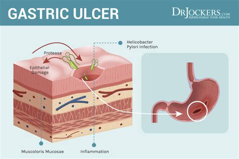 Stomach Ulcers Causes And Natural Support Strategies DrJockers Com