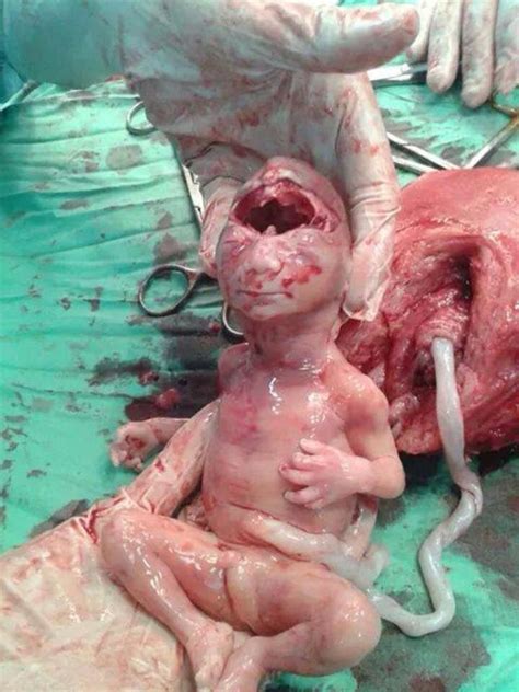 【閲覧注意】殺された妊婦のお腹から出てきた胎児・・・ 画像 ポッカキット
