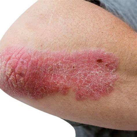 Apremilast An Option For Mild To Moderate Plaque Psoriasis