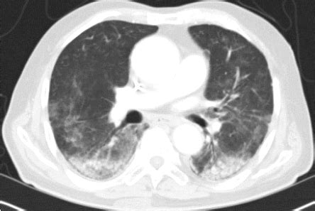 HRCT Scan Taken Before Transbronchial Lung Biopsy Showed Diffuse And