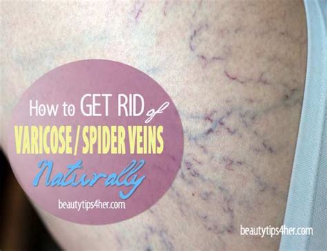 How To Get Rid Of Varicose Spider Veins Naturally And Fast