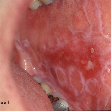Reticular And Erosive Oral Lichen Planus On The Buccal Mucosa Download Scientific Diagram