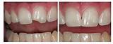 Home Tooth Repair Chipped Tooth Pictures