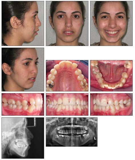 Unusual Extraction Combinations In Patients With Impacted Maxillary