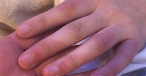Alberta Mom Warns Of Frostbite Danger After Teenager Freezes Hands