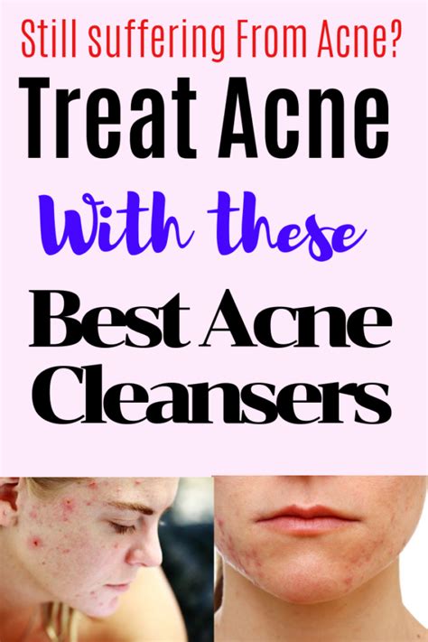 Best Acne Cleanser Reviews Best Washes For Acne