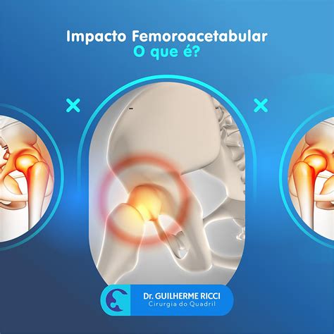 Cirurgia Impacto Femoroacetabular Preço